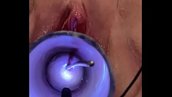 Inserting sound into cervix